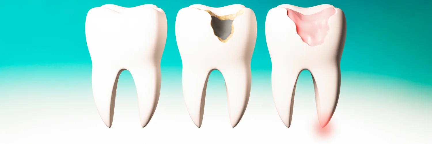 Progresión en tres etapas de un molar sano a caries temprana y a un diente infectado con absceso en la punta de la raíz