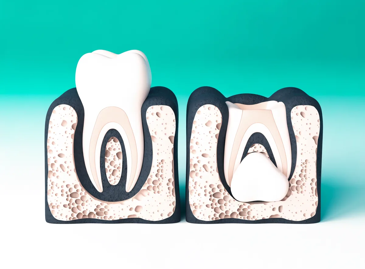 Comparación en corte de un molar erupcionado junto a un molar impactado inclinado bajo el hueso
