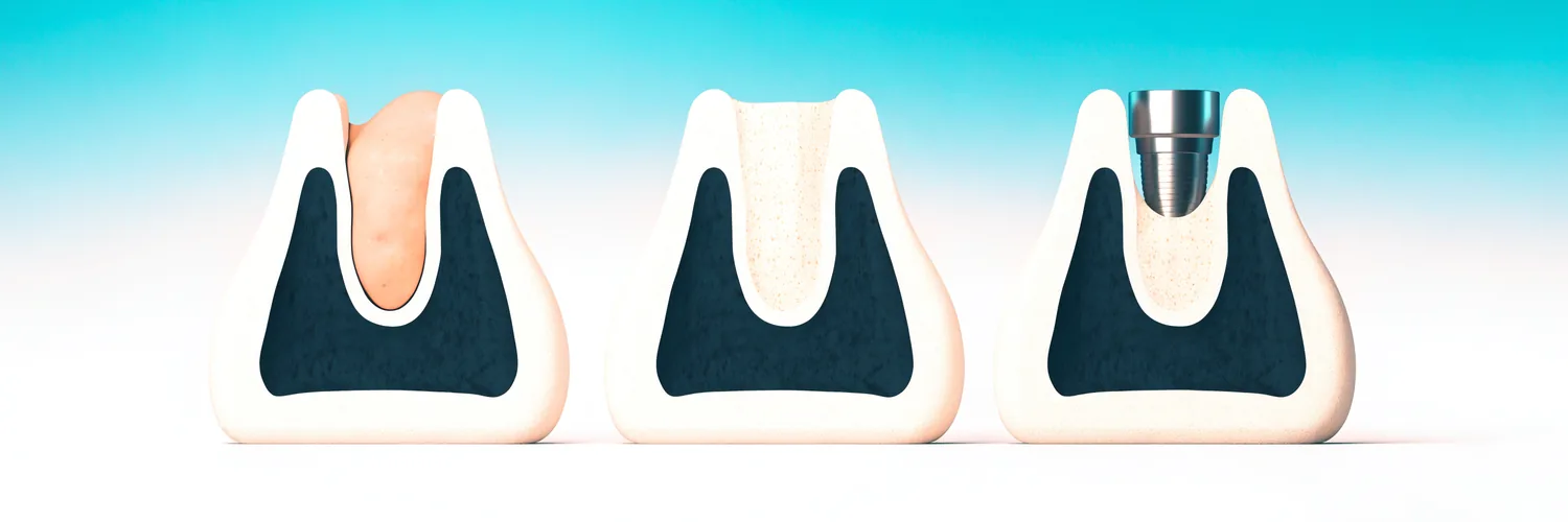 Corte en tres etapas de un alvéolo de extracción: coágulo en cicatrización, material de injerto óseo y cresta sanada con un implante dental