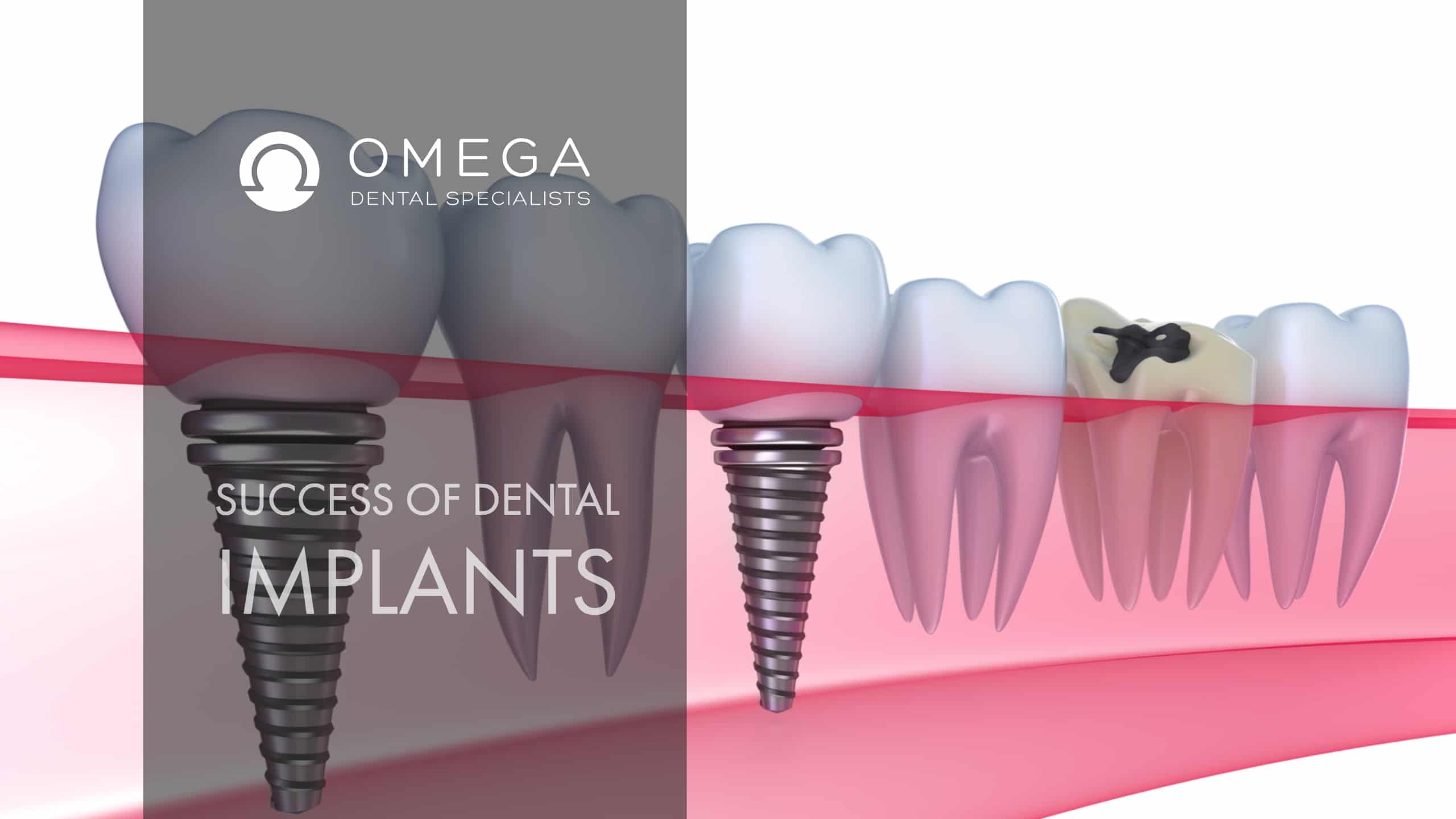 Success with Dental Implants