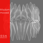 Wisdom Teeth Removal