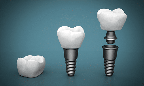 Contemporary Dental Implants