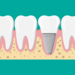 Success Rate of Dental Implant