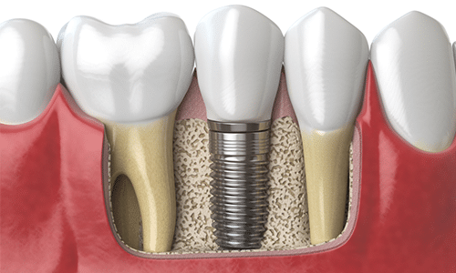 Right Size Dental Implant