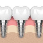 Dental Implants in Houston