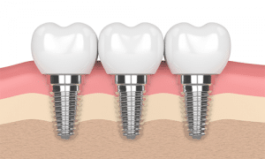 teeth shifting due to dental implants
