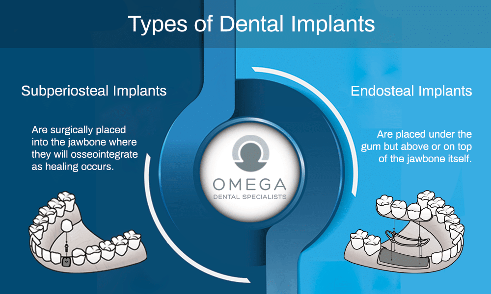 Dental Implants Options