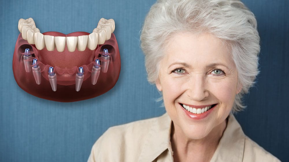 6 Dental Implants