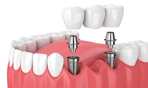 Dental Implant Evaluation