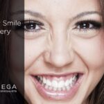 Gummy Smile Surgery Cost