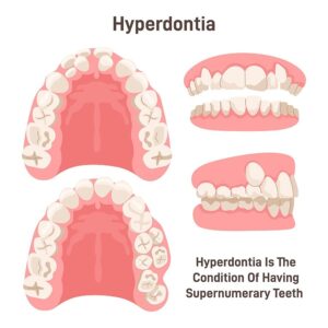 What is Hyperdontia? | Omega Dental Houston TX