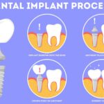 how does teeth implants work