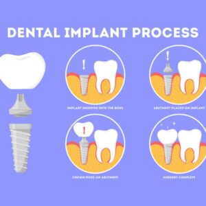 Dental Implant Surgery Step By Step | Omega Dental Houston TX