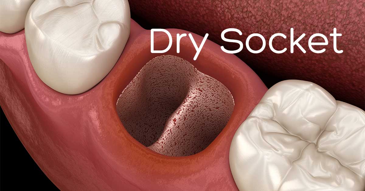 What is A Dental Dry Socket?