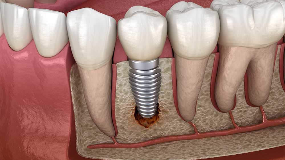 cost of a single tooth implant