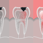 Root Canal Treatment Omega Dental Specialists Houston TX