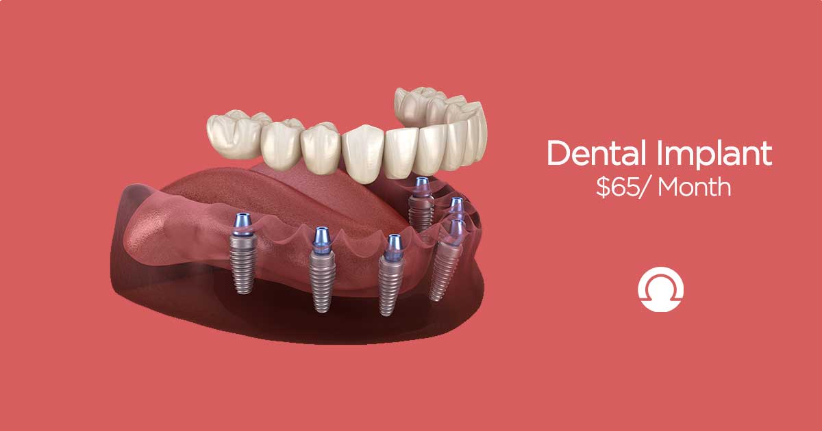 Full Mouth Dental Implants