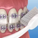 How to brush your braces
