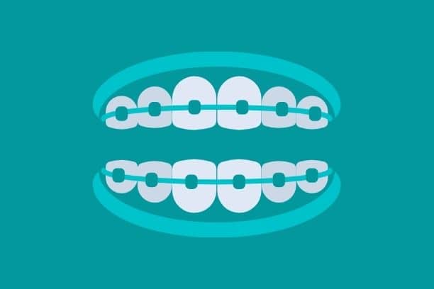 How Much Does Dental Braces Cost For Adults in Houston, Texas?