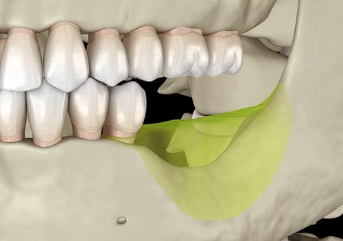bone recession after tooth loss