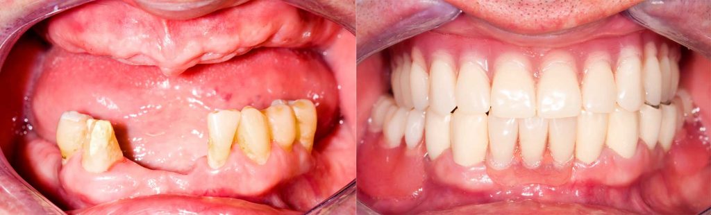Permanent teeth with dental implants Houston Texas