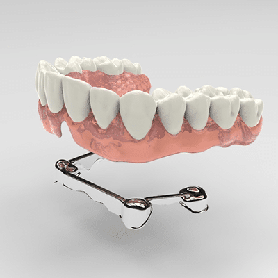 implant-over-denture-Houston