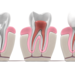 Is There an Alternative to Root Canal Treatment?