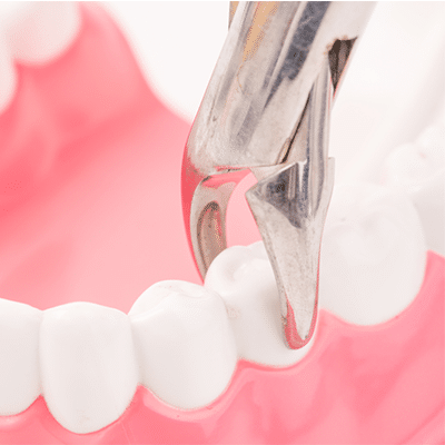 tooth-removal-Houston