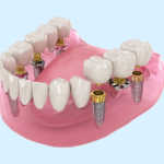 Full Mouth Dental Implants