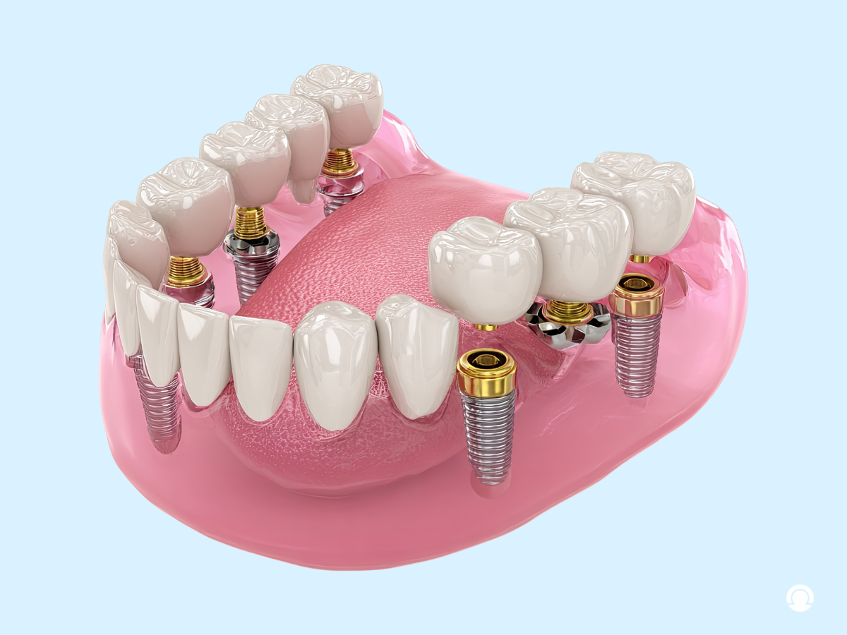 Full Mouth Dental Implants
